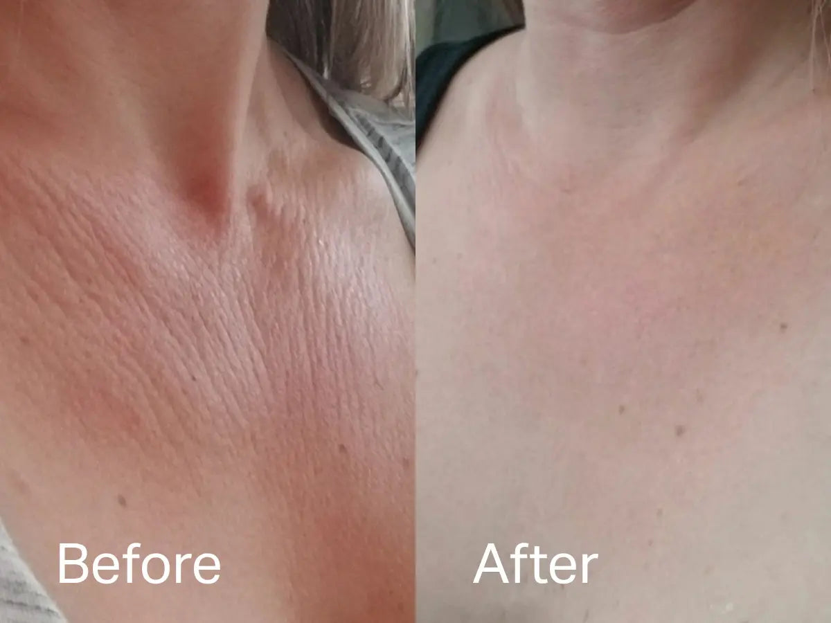 Chest Wrinkle Patch