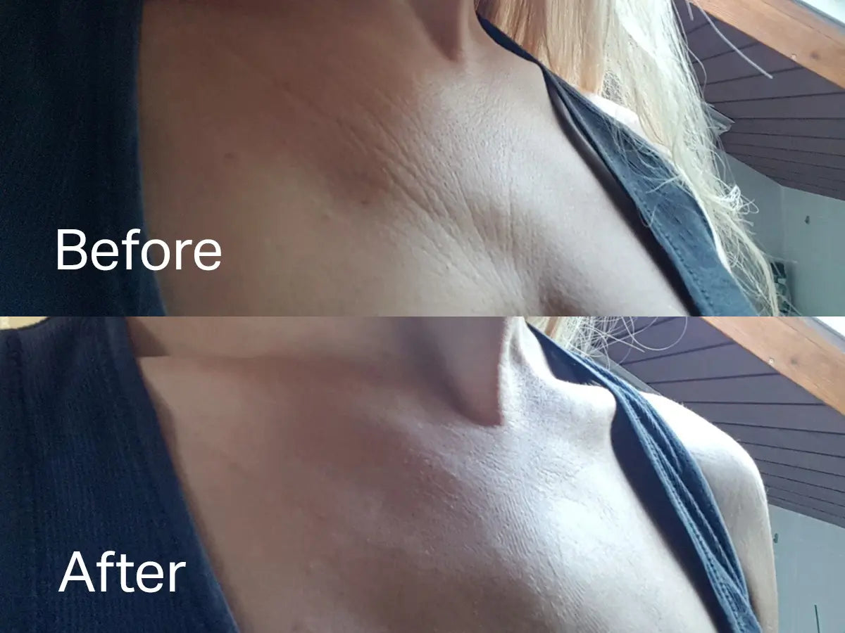 Chest Wrinkle Patch