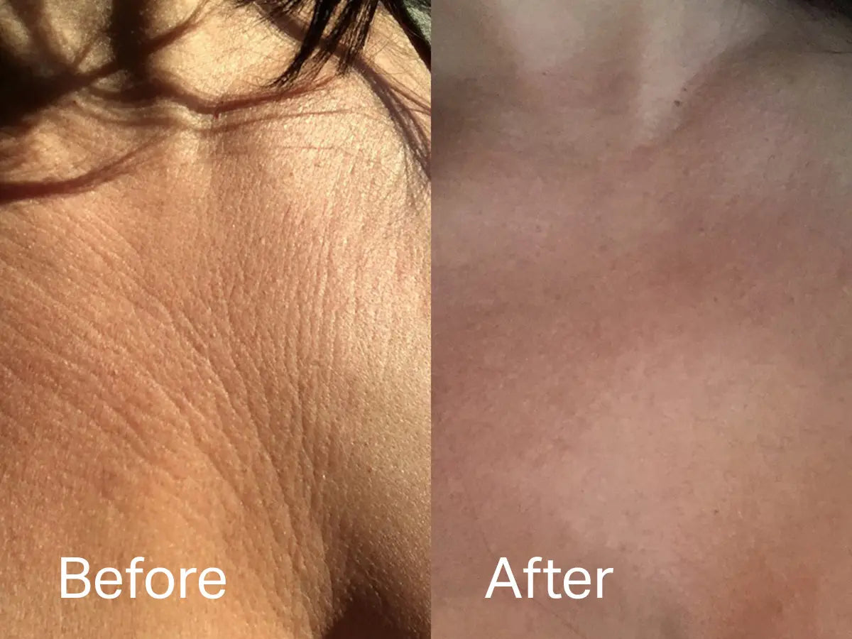 Chest Wrinkle Patch