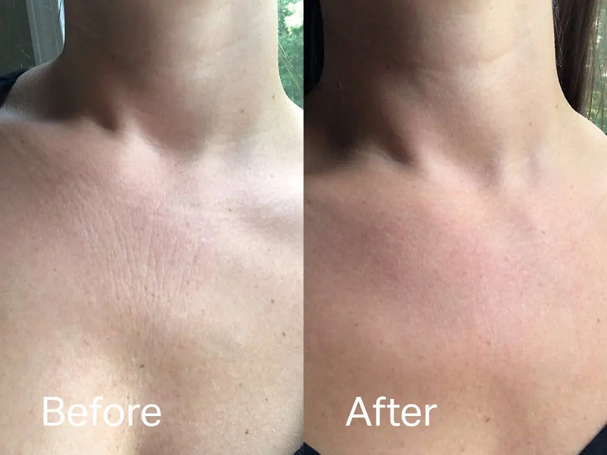 Chest Wrinkle Patch